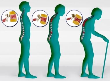 Osteoporoz